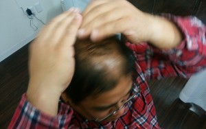 薬用育毛剤オメガプロを頭頂部を中心に頭皮を軽く叩きながら浸透させてくハゲ部部長（仮）