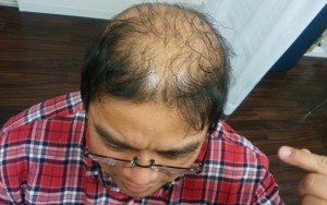 薬用育毛剤オメガプロを頭頂部を中心に頭皮に塗りこみ浸透させるハゲ部部長（仮）