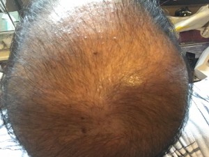 薬用育毛剤オメガプロ使用直前のハゲ部部長(仮)